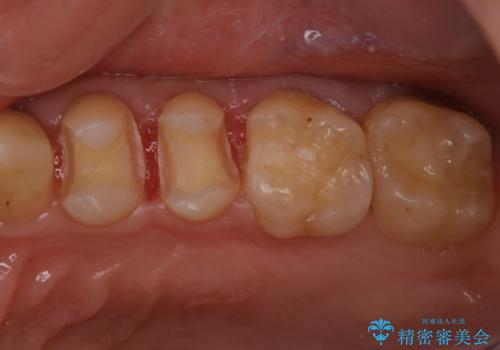 奥歯の着色が気になる セラミック治療の治療中