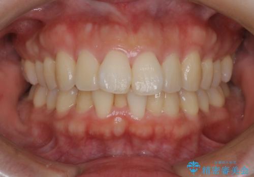 【審美装置】癒合歯がある方の治療の症例 治療前