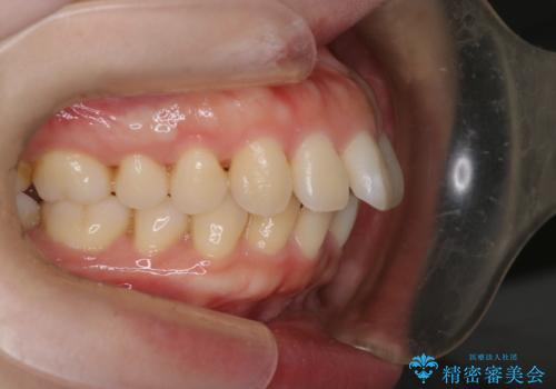 【審美装置】癒合歯がある方の治療の治療前