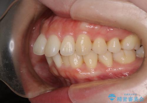 【審美装置】癒合歯がある方の治療の治療前