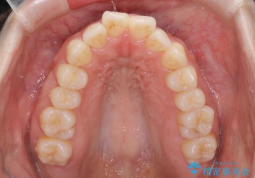 【審美装置】癒合歯がある方の治療の治療前