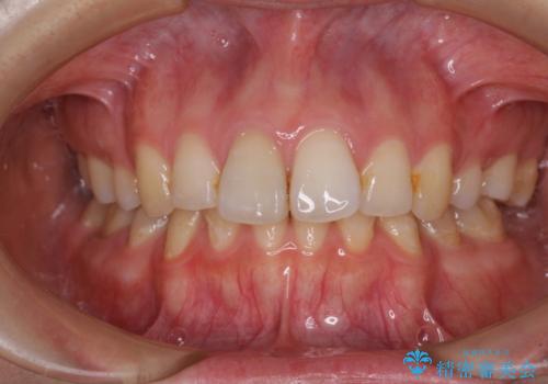 部分矯正を併用した奥歯のインプラント治療の治療前