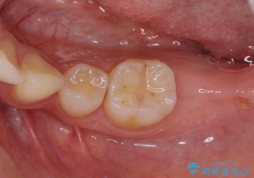 部分矯正を併用した奥歯のインプラント治療の症例 治療前