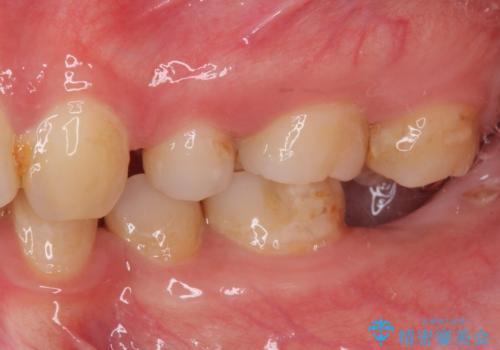 部分矯正を併用した奥歯のインプラント治療の治療前