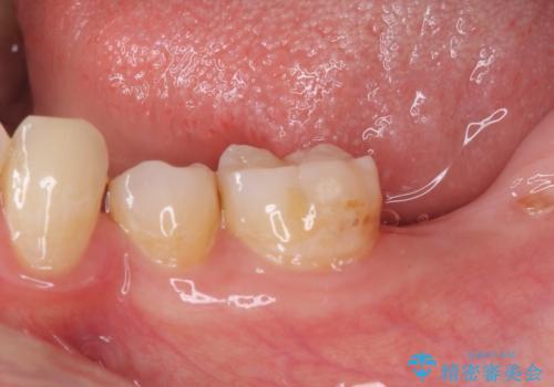 部分矯正を併用した奥歯のインプラント治療の治療前
