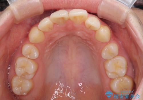 部分矯正を併用した奥歯のインプラント治療の治療前