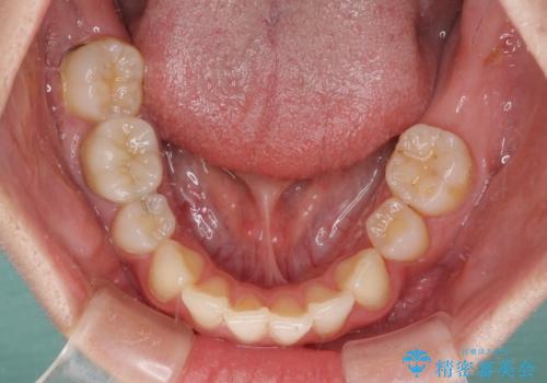 部分矯正を併用した奥歯のインプラント治療の治療前