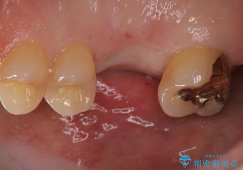 欠損している歯をインプラント治療により元のように咬めるようにの治療前