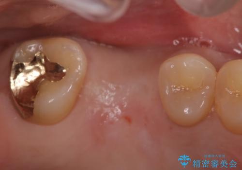 欠損している歯をインプラント治療により元のように咬めるようにの治療前