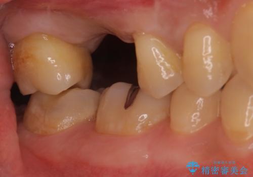欠損している歯をインプラント治療により元のように咬めるようにの症例 治療前