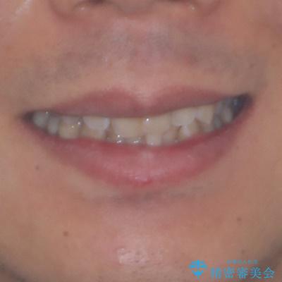 ワイヤー装置をインビザラインへ 装置変更での矯正治療の治療前(顔貌)