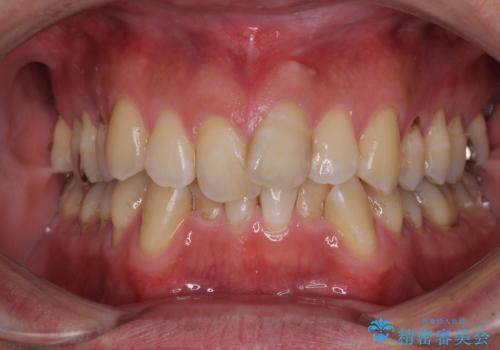 ワイヤー装置をインビザラインへ 装置変更での矯正治療の治療前