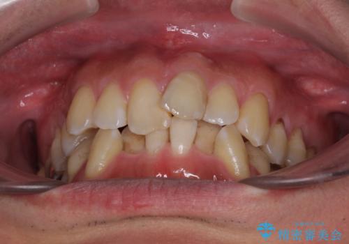 ワイヤー装置をインビザラインへ 装置変更での矯正治療の治療前