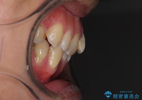 ワイヤー装置をインビザラインへ 装置変更での矯正治療の治療前