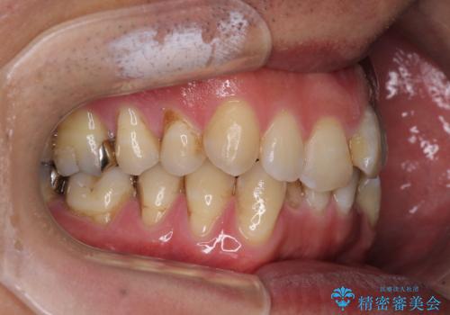 ワイヤー装置をインビザラインへ 装置変更での矯正治療の治療前