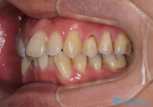 ワイヤー装置をインビザラインへ 装置変更での矯正治療の治療前