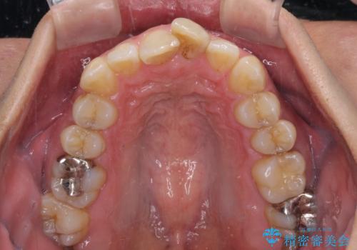 ワイヤー装置をインビザラインへ 装置変更での矯正治療の治療前