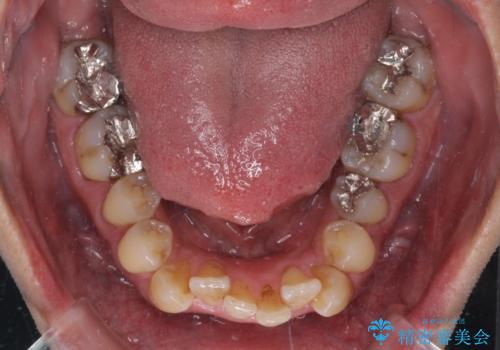 ワイヤー装置をインビザラインへ 装置変更での矯正治療の治療前