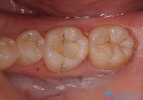 歯が黒いのが気になるの治療中