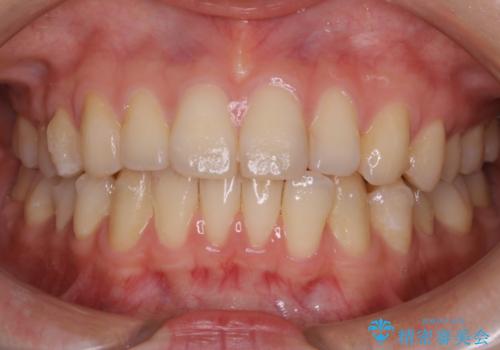【非抜歯】部分矯正で自信の持てる歯並びへの治療中