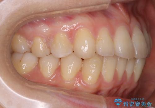 【非抜歯】部分矯正で自信の持てる歯並びへの治療中