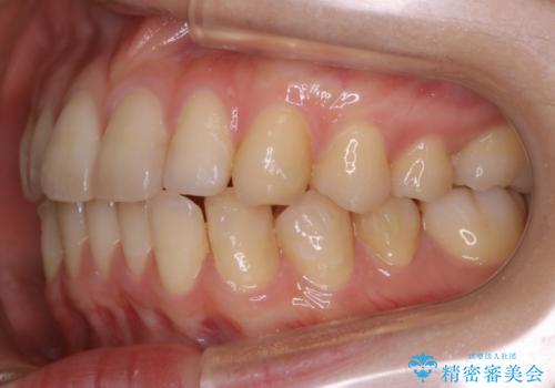 【非抜歯】部分矯正で自信の持てる歯並びへの治療中