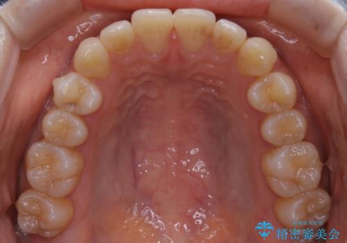 【非抜歯】部分矯正で自信の持てる歯並びへの治療中