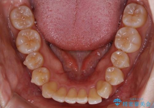 【非抜歯】部分矯正で自信の持てる歯並びへの治療中