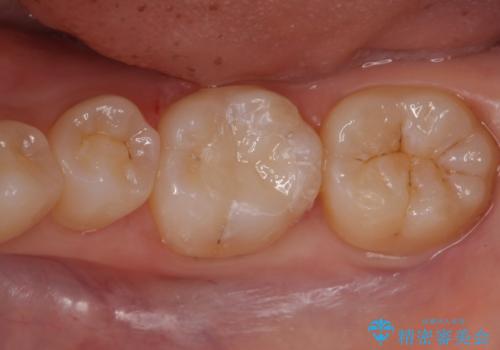 歯が黒いのが気になるの治療後