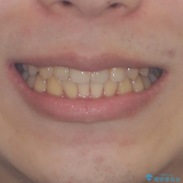 前歯のデコボコを治したい　インビザライン矯正治療の治療前（顔貌）