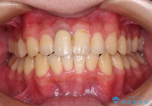 前歯のデコボコを治したい インビザライン矯正治療の治療中