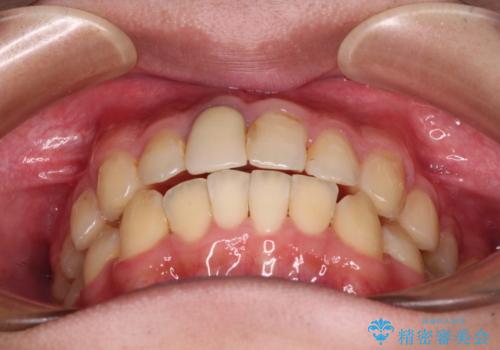 前歯のデコボコを治したい インビザライン矯正治療の治療中