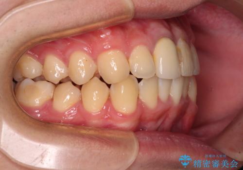 前歯のデコボコを治したい インビザライン矯正治療の治療中