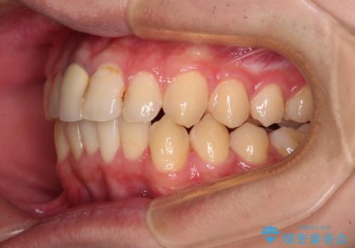 前歯のデコボコを治したい インビザライン矯正治療の治療中