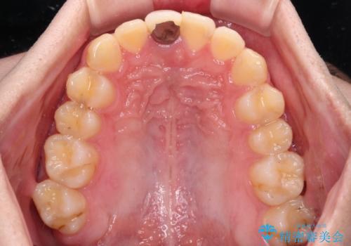 前歯のデコボコを治したい インビザライン矯正治療の治療中