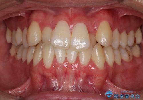 【非抜歯】八重歯を治す　マウスピース矯正の症例 治療前