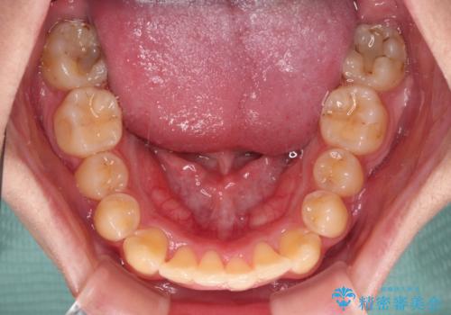 前歯のデコボコを治したい インビザライン矯正治療の治療中