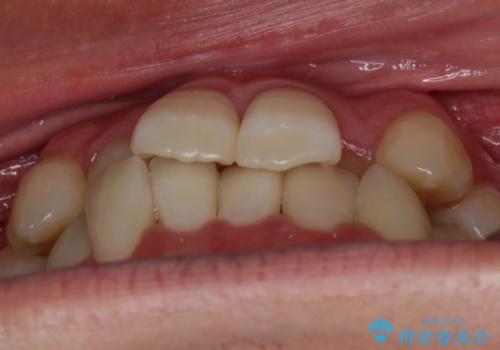 【非抜歯】八重歯を治す マウスピース矯正の治療前