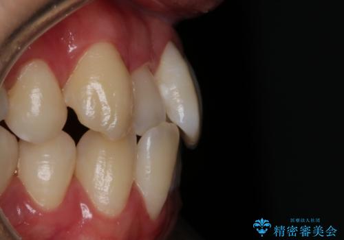 【非抜歯】八重歯を治す　マウスピース矯正の治療前