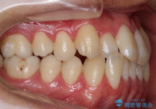 【非抜歯】八重歯を治す マウスピース矯正の治療前