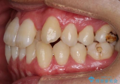 【非抜歯】八重歯を治す マウスピース矯正の治療前