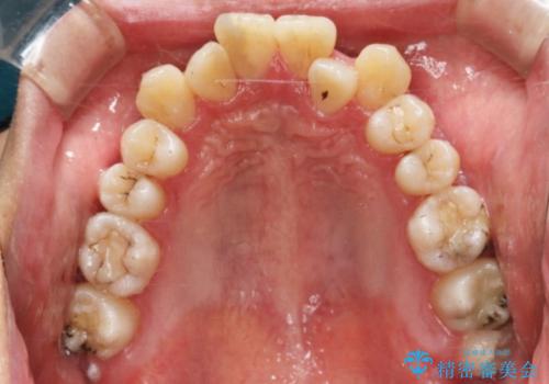 【非抜歯】八重歯を治す マウスピース矯正の治療前