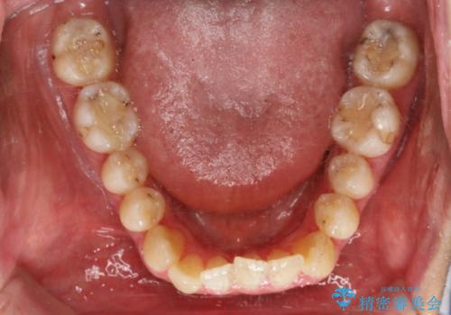 【非抜歯】八重歯を治す　マウスピース矯正の治療前