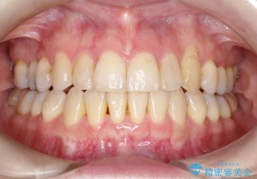 飛び出した八重歯が気になる!非抜歯でマウスピース(インビザライン)による治療症例の症例 治療後