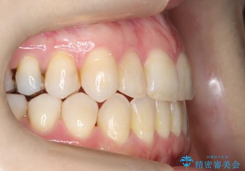 飛び出した八重歯が気になる!非抜歯でマウスピース(インビザライン)による治療症例の治療後