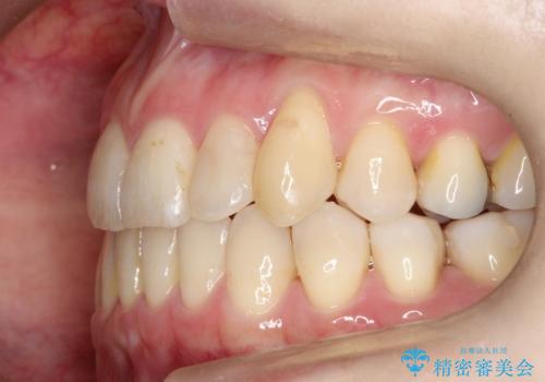 飛び出した八重歯が気になる!非抜歯でマウスピース(インビザライン)による治療症例の治療後