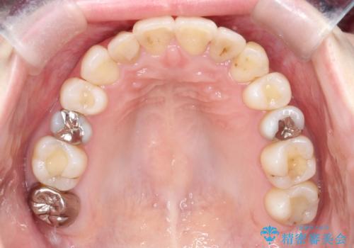 飛び出した八重歯が気になる!非抜歯でマウスピース(インビザライン)による治療症例の治療後