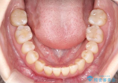 飛び出した八重歯が気になる!非抜歯でマウスピース(インビザライン)による治療症例の治療後