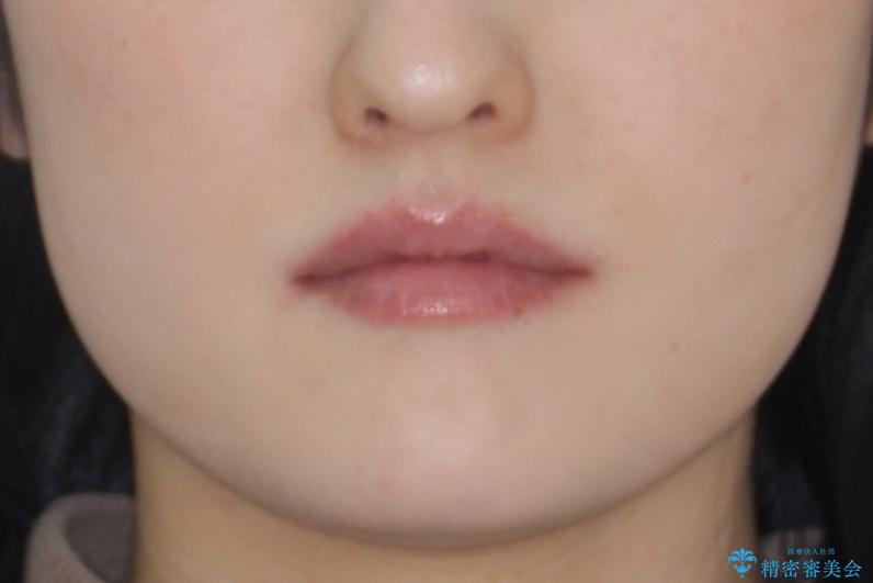 飛び出した八重歯が気になる!非抜歯でマウスピース(インビザライン)による治療症例の治療後(顔貌)