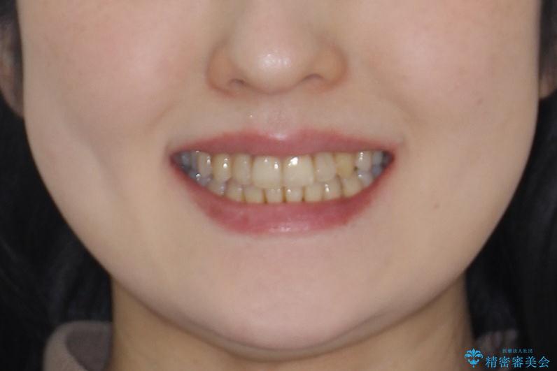 飛び出した八重歯が気になる!非抜歯でマウスピース(インビザライン)による治療症例の治療後(顔貌)